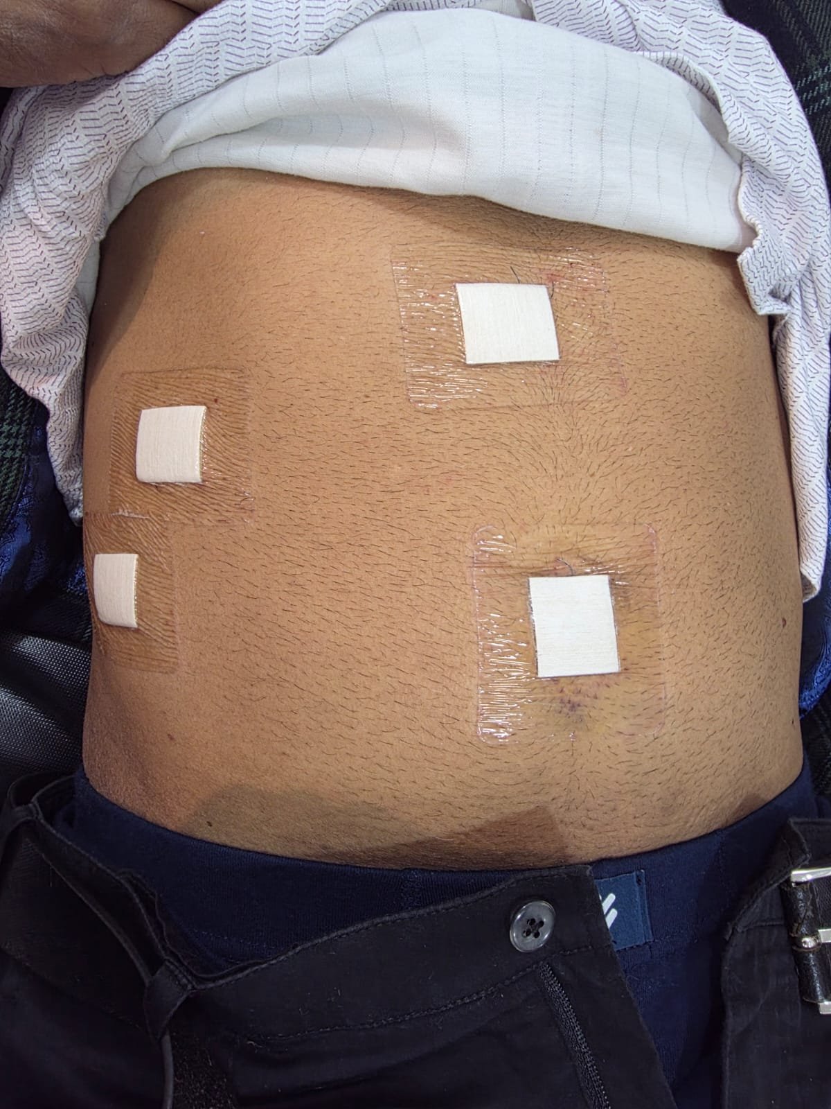 POST-OPERATIVE SUTURE CARE AWARENESS