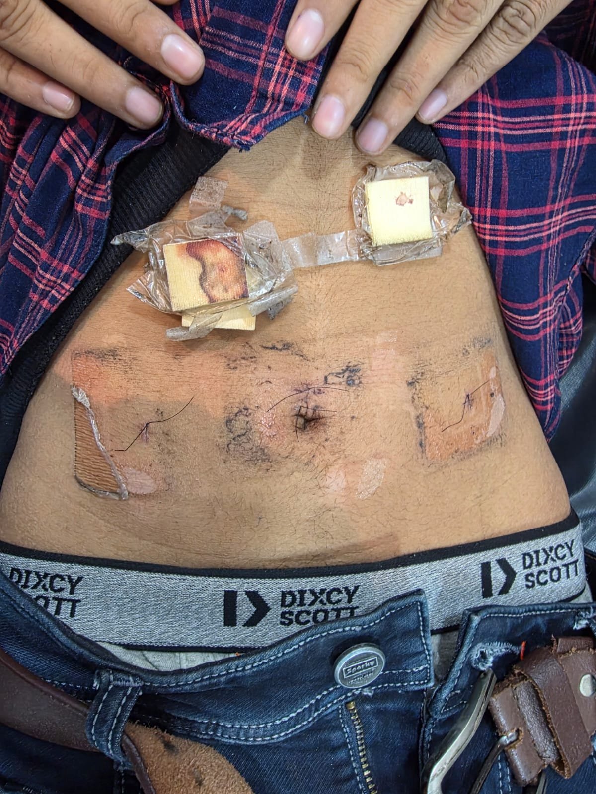 POST-OPERATIVE SUTURE CARE AWARENESS