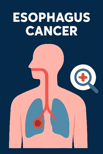 Esophagus Cancer