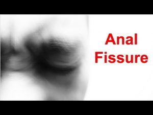 anal fissure