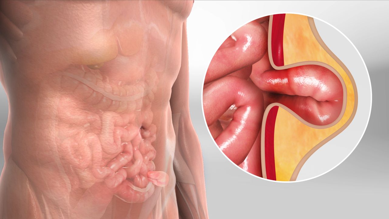 What is Hernia | Dr. Abhimanyu Kapoor