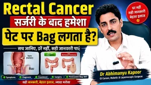 Rectal Cancer Surgery: Does Every Patient Need a Permanent Colostomy Bag? Myths vs Facts Explained